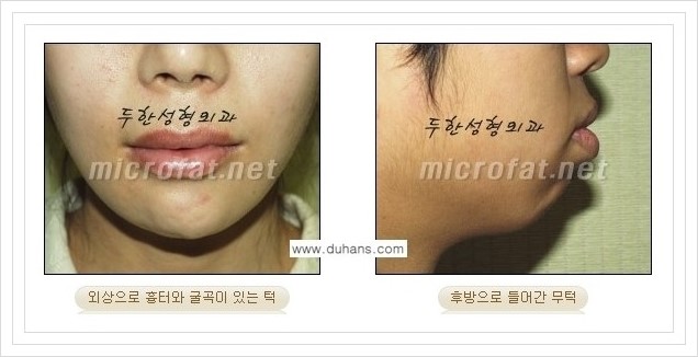 ⁠⁠[두한성형외과 경쟁력 미세지방이식] - [턱 미세지방이식 - 안면윤곽 교정 안내] 관련 이미지 3