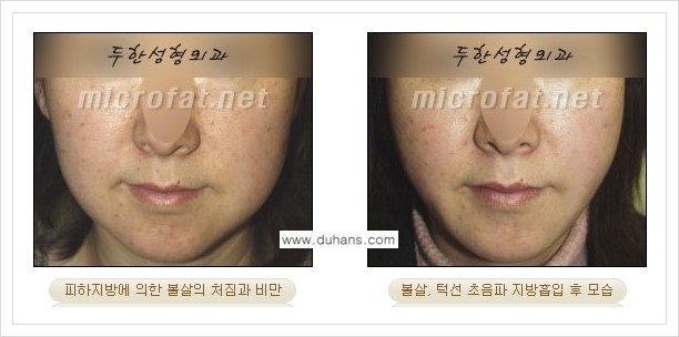 [두한성형외과 겨울엔 지방흡입을] - [볼살, 눈밑, 턱선의 초음파 미세지방흡입 1.] 관련 이미지 4