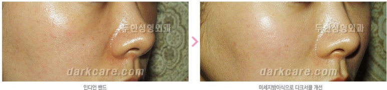 [두한성형외과 자가지방이식] - [인디언주름] 관련 이미지 26