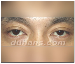 눈성형잘하는곳 두한성형외과 - 겹쌍꺼풀 관련 이미지 3