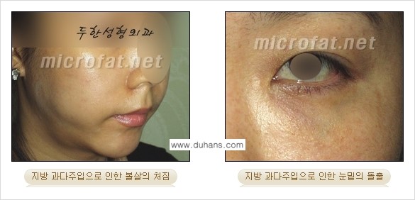 [두한성형외과 경쟁력 미세지방이식] - [타병원에서의 미세지방이식 이후 부작용 교정의 대상 안내] 관련 이미지 2