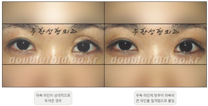 [두한성형외과 쌍커플재수술] - [비대칭 쌍커풀 라인] 관련 이미지 7