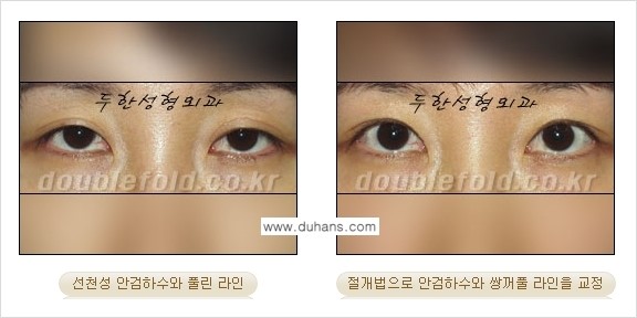 [두한성형외과 NO.1 "극한 눈(쌍꺼풀 재수술)"] - [안검하수(졸린눈매) 재수술 안내 3.] 관련 이미지 6