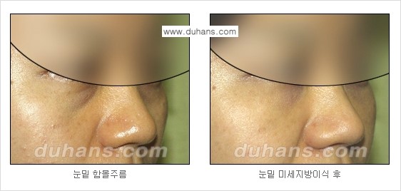 [두한성형외과 경쟁력 주름성형] - [미세지방이식을 이용한 주름교정 안내 - 눈밑주름, 입가주름, 팔자주름 2.] 관련 이미지 15