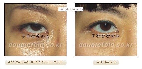 [두한성형외과 경쟁력 쌍꺼풀 재수술, 극한 재수술]- [쌍꺼풀 재수술의 성공 조건(Condition of successful reoperation) 관련 이미지 16