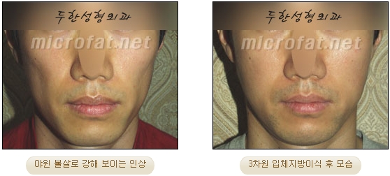 얼굴지방이식 두한성형외과 - 볼지방이식 관련 이미지 32