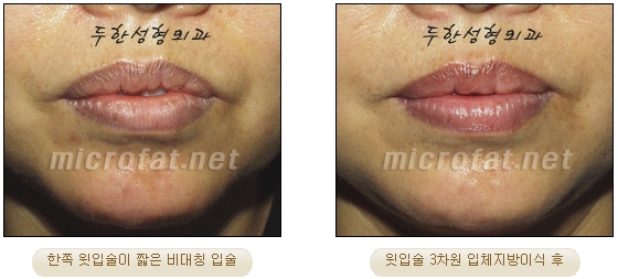 [Duhan Plastic Surgery Lip Surgery] - [Lip Correction Fat Grafting] image 23