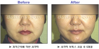[Duhan Plastic Surgery Clinic Aesthetic Procedures] - [Square Jaw Botox] image 29