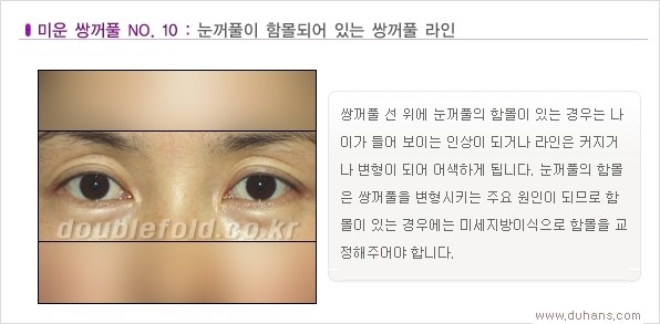 [두한성형외과 경쟁력 쌍꺼풀 재수술, 극한 눈재수술] - [Dr. 컬럼 - 재수술의 목표] 관련 이미지 13