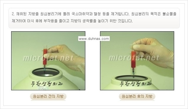 [두한성형외과 경쟁력 미세지방이식] - [입술 미세지방이식 안내 1.] 관련 이미지 5
