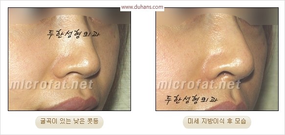 [두한성형외과 경쟁력 코성형 리더] - [자연스럽고 오똑한 콧망울! 코성형 방법]​ 관련 이미지 45