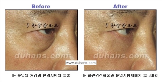 [두한성형외과의 상큼하고 환한 젊은 눈매완성] - [하안검 성형술 ②] 관련 이미지 11