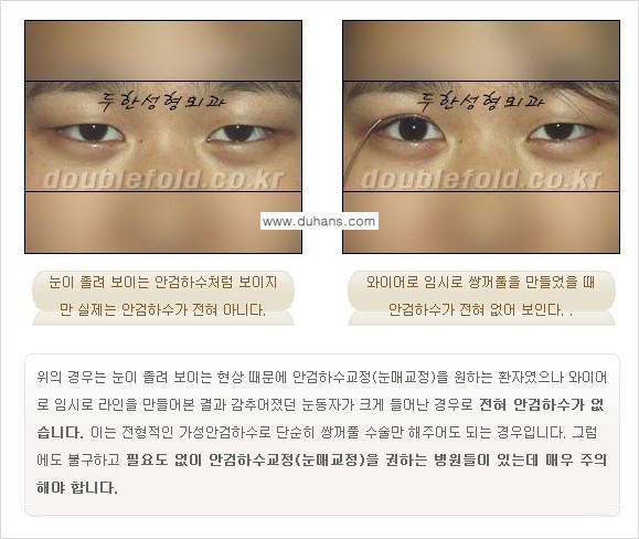[두한성형외과 NO.1 "극한 눈(쌍꺼풀 재수술)"] - [안검하수(졸린눈매) 재수술 안내 1.] 관련 이미지 5