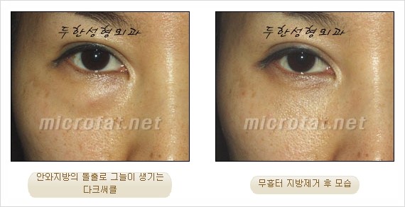 [두한성형외과 쌍커풀수술] - [눈성형 방법에 대한 자주하는 질문과 답변] 관련 이미지 172