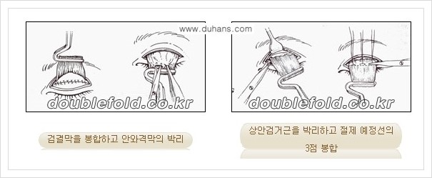 [두한성형외과 경쟁력 쌍꺼풀 재수술, 극한 재수술] - [여러가지 안검하수 수술 방법 안내] 관련 이미지 4