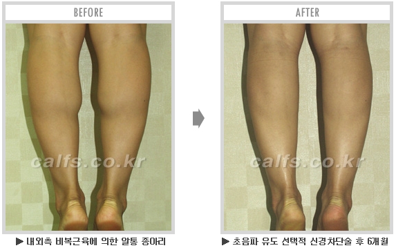 [종아리성형 두한성형외과] - [종아리수술에 대한 자주하는 질문과 답변 모음] 관련 이미지 70