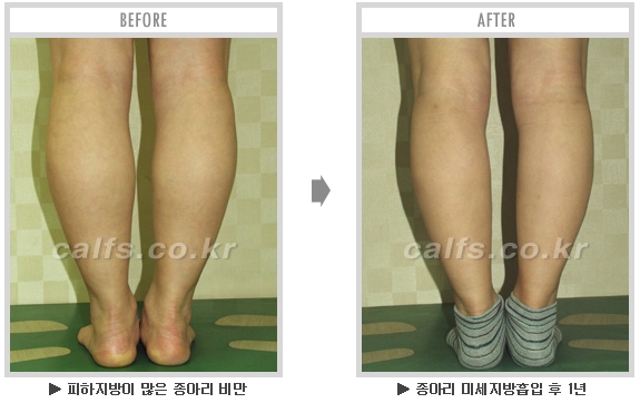[종아리성형 두한성형외과] - [종아리수술에 대한 자주하는 질문과 답변 모음] 관련 이미지 81