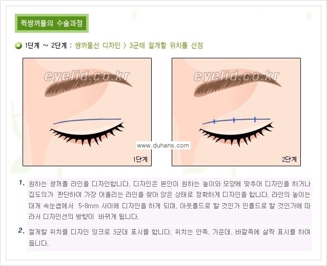 [두한성형외과 경쟁력 눈성형] - [퀵쌍꺼풀 수술] 관련 이미지 2