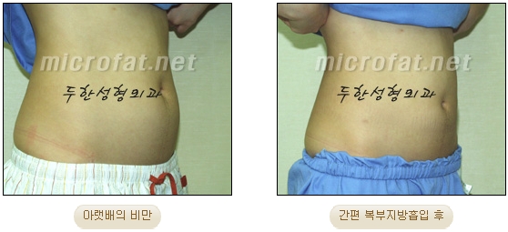 두한성형외과 지방흡입 - 부위별 안전 지방흡입 관련 이미지 18