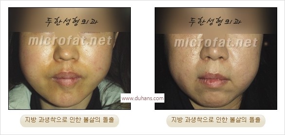 [두한성형외과 경쟁력 미세지방이식] - [타 병원의 지방이식 부작용 교정 - 정교한 마이크로 지방이식, 흡입 안내] 관련 이미지 2