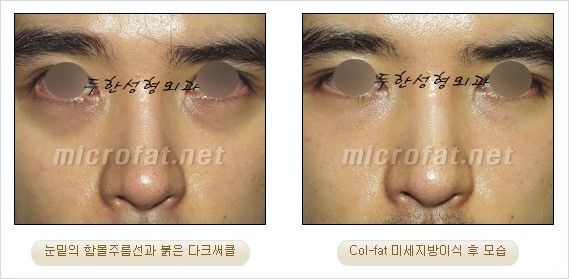 [두한성형외과 경쟁력 지방이식 리더] - [Col-fat(콜펫)지방이식, 3차원 입체지방이식, 2차원 평면지방이식] 관련 이미지 60