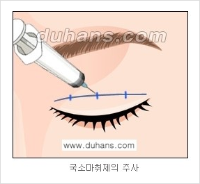 ​[두한성형외과 경쟁력 눈성형] - [자연스러운면서 매력적인 쌍꺼풀 퀵 쌍꺼풀 수술 안내] 관련 이미지 6