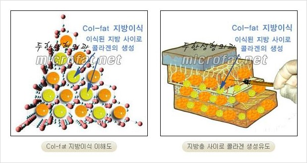 [두한성형외과 경쟁력 미세지방이식] - [지방이식 특허 Col-fat 미세지방이식 성공사례 안내] 관련 이미지 1