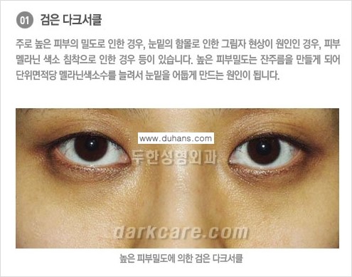 [두한성형외과 NO.1 경쟁력] - [원인과 색에 따른 다크써클의 종류] 관련 이미지 7