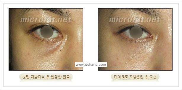 [두한성형외과 경쟁력 지방이식] - [지방이식 부작용 - 지방이식 후 지방이식 과다주입, 과다생착의 교정 안내] 관련 이미지 8