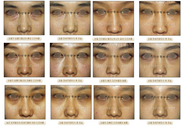 눈밑 다크써클 개선 원리 관련 이미지 12