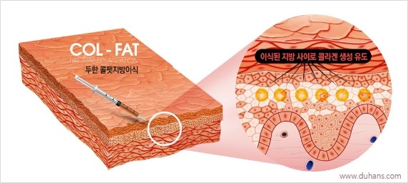 [두한성형외과 경쟁력 눈밑성형] - [눈밑 미세지방이식의 이해도 안내] 관련 이미지 1
