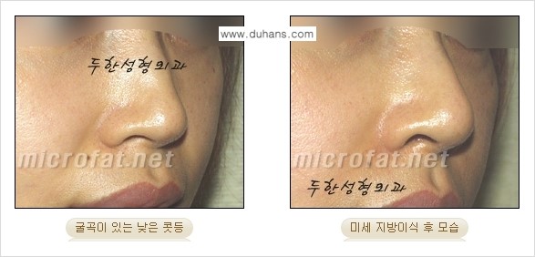 ​[두한성형외과의 No.1 경쟁력 미세(자가)지방이식] - [코높힘 미세(자가)지방이식 ②] 관련 이미지 4