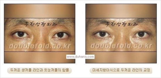 [두한성형외과 경쟁력 눈성형] - [쌍꺼풀 재수술 과정과 쌍꺼풀 재수술 실패의 원인, 쌍꺼풀 재수술의 성공 요건] 관련 이미지 41