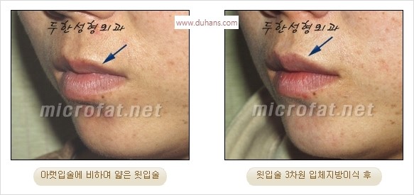 ​​[두한성형외과 경쟁력 미세지방이식] - [볼륨감 있는 입술성형] 관련 이미지 14
