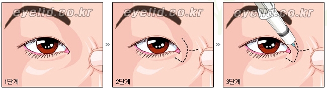 [Duhan Plastic Surgery Eyelid Surgery] - [Epicanthoplasty, Medial Canthoplasty] image 7