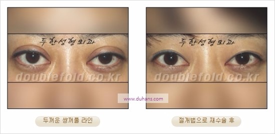 [두한성형외과 경쟁력 눈성형] - [쌍꺼풀 재수술에 대한 최선의 대안 제시] 관련 이미지 14