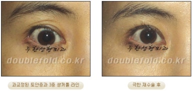 쌍꺼풀수술 두한성형외과 - 쌍커풀재수술의 문제점 관련 이미지 29