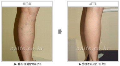 ​[두한성형외과 종아리수술] - [나에게 맞는 종아리성형방법] 관련 이미지 45