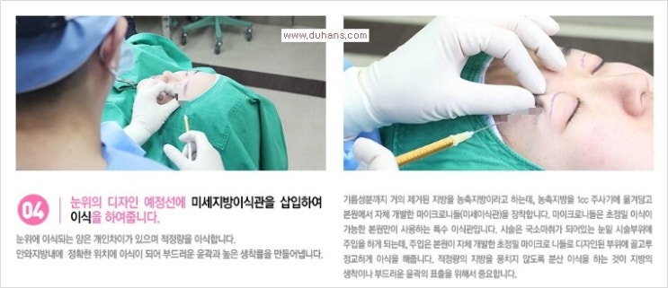 [두한성형외과 경쟁력 다크써클 치료] - [다크써클 + 눈위 지방이식 콤비 프로그램] 관련 이미지 10