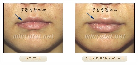 [두한성형외과 경쟁력 지방이식 리더] - [Col-fat(콜펫)지방이식, 3차원 입체지방이식, 2차원 평면지방이식] 관련 이미지 37