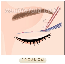 두한성형외과 쌍커풀재수술 - 삼중 쌍커풀 라인 교정 관련 이미지 12