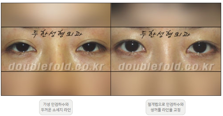 [Ptosis, Duhan Plastic Surgery] - [Sleepy-Looking Eyes, Ptosis Eye Correction] image 14