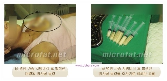 [두한성형외과 경쟁력 지방이식] - [두한 자가지방이식 클리닉 안내]​ 관련 이미지 63
