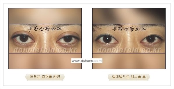 [두한성형외과 경쟁력 쌍꺼풀 재수술] - [두껍고 어색한 라인 교정하는 방법 안내 2.] 관련 이미지 8
