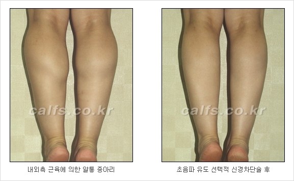 [두한성형외과 경쟁력 종아리성형] - [초음파 유도 선택적 신경차단술 안내 ④] 관련 이미지 4