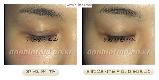 [두한성형외과 경쟁력 쌍꺼풀 재수술 리더] - [쌍꺼풀 흉터선, 쌍꺼풀 흉터 유착 교정술 안내] 관련 이미지 12