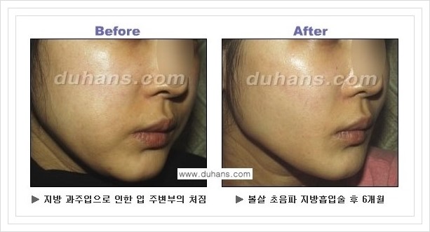 ​​[두한성형외과 경쟁력 지방흡입] - [아름다운 얼굴 윤곽선을 위한  볼살지방흡입, 턱선지방흡입 안내] 관련 이미지 21