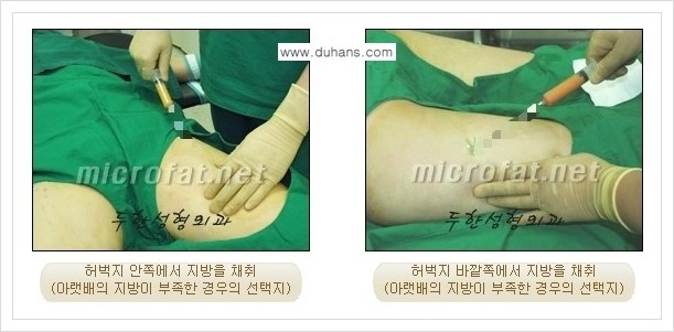 [두한성형외과 경쟁력 미세지방이식] - [두한 미세지방이식 클리닉의 특징 안내] 관련 이미지 5