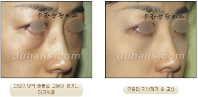 [두한성형외과 지방제거] - [눈두덩이지방제거, 눈밑지방제거] 관련 이미지 40