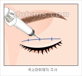 [두한성형외과 경쟁력 눈성형 리더] - [아름다운 눈매를 위한 쌍꺼풀 수술 안내] 관련 이미지 4